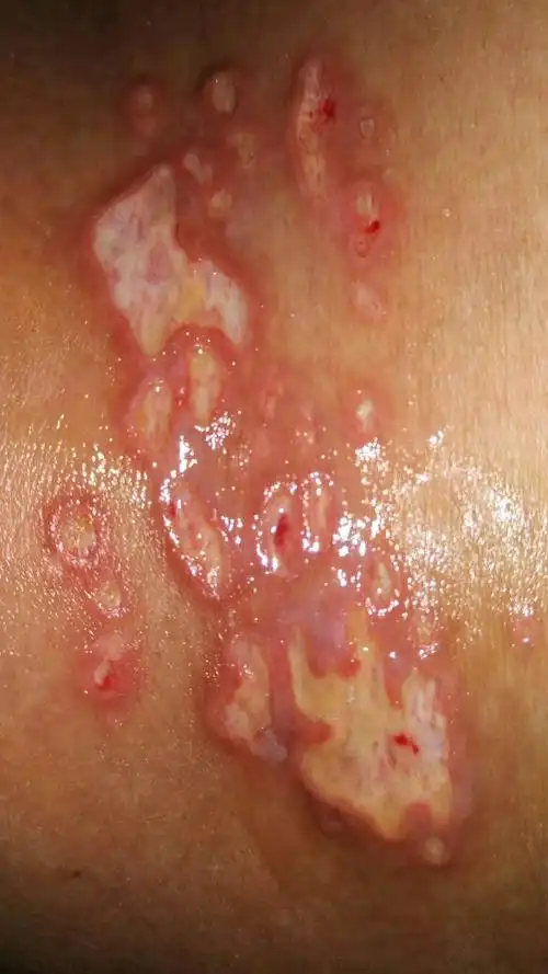 湿疹引起溃烂,半个多月没好,现在在用碘伏消毒后用百多邦,这样可以吗?