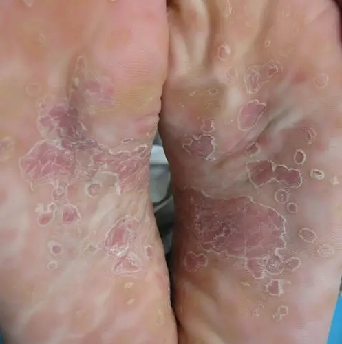 人得了一期梅毒图片