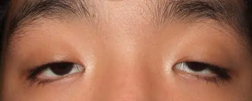 bio整形外科研修:洪星杓院长传授眼睑下垂手术