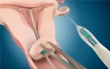 3d动画演示产妇生孩子后上环全过程, 看着都疼!