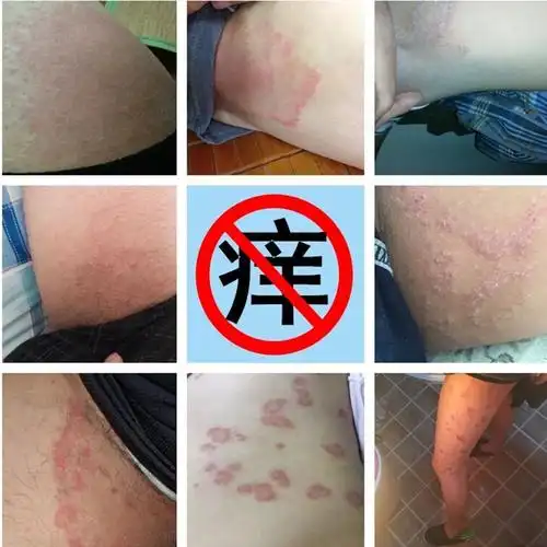 肤毒清治疗皮肤瘙痒阴囊湿疹荨麻疹牛皮股藓癣皮肤病过敏止痒药膏_好