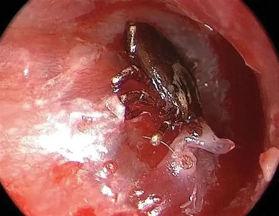 她耳朵里一直传来声音原来是蜘蛛在里面爬