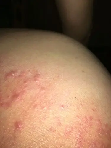 夏天到了,屁股上就老长这个,有什么方法治疗?