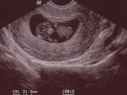 怀孕6周可以看见胎心胎芽吗 67怀孕6周的胎心特征