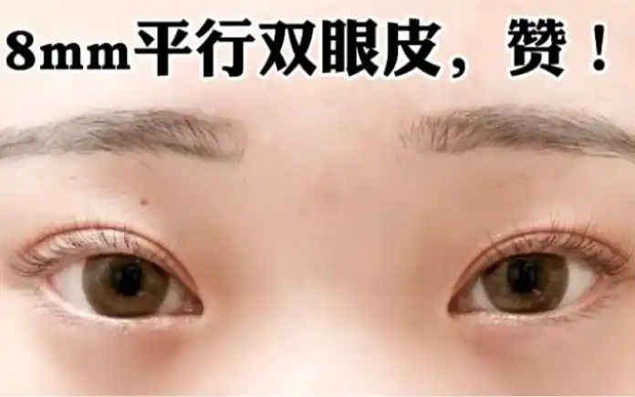 8mm平行双眼皮,赞!