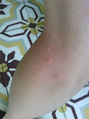 本人 男,23岁 身上莫名其妙的起红疙瘩,前几天胳膊上的消了,现在腿上