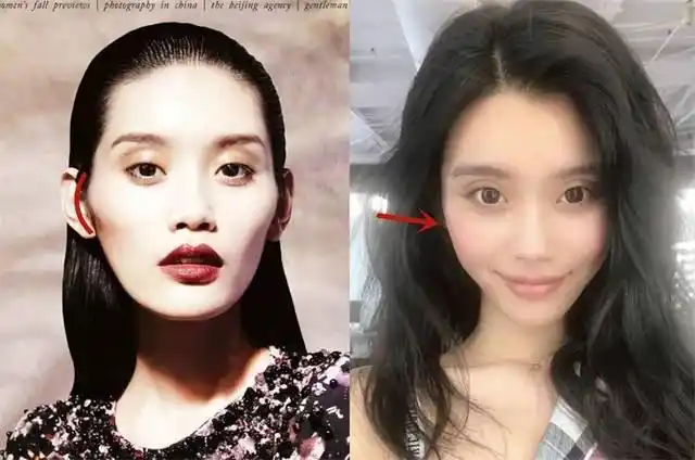 明星颧骨内推图片