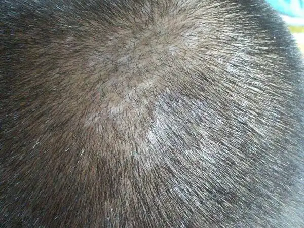 请问是头皮癣吗