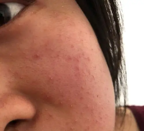 脸长了这些白点点和红痘痘,朋友看了说是毛囊炎!