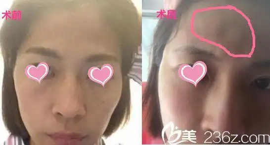 结合一些自体脂肪面部填充的真实案例自体脂肪填充失败的原因是什么