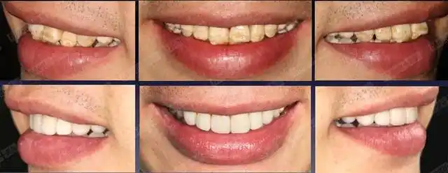 案例丨氟斑牙美加贴面美白修复案例一则