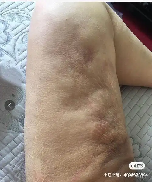 脂肪吸收:这个比较常见,成活率不高,跟技术,个体,后期的护理等都有