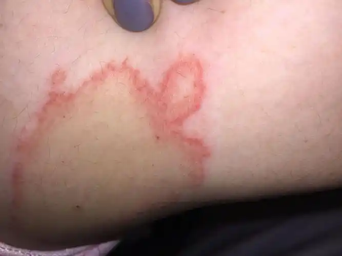 求医!急 症状:骚痒,尤其是遇热,红色部位突出皮肤表面