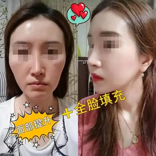 什么情况下做全脸脂肪填充,全脸脂肪填充要多少钱