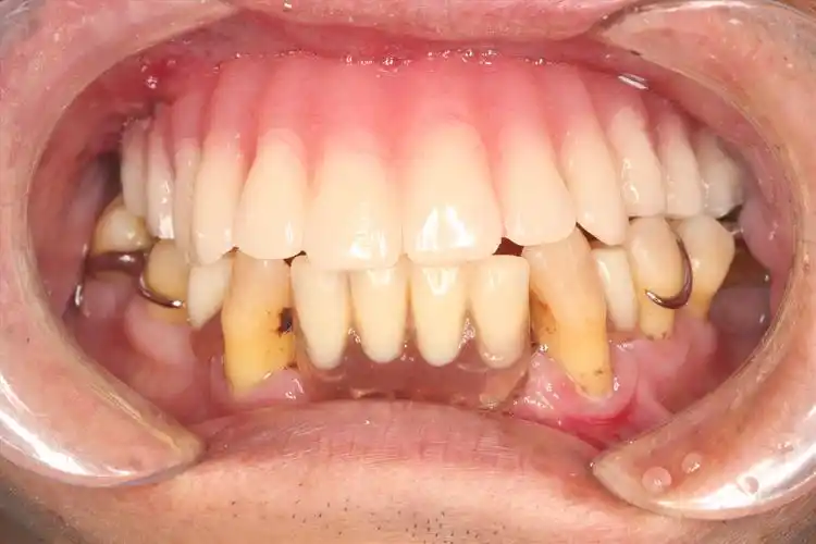 种植牙案例-马先生