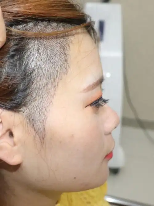 种植鬓角哪里医院好_种植鬓角哪个医院好_种植鬓角医院哪家好