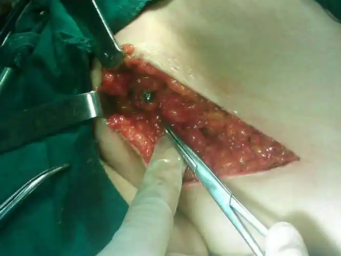 乳腺癌前哨淋巴结活检 - 好大夫在线