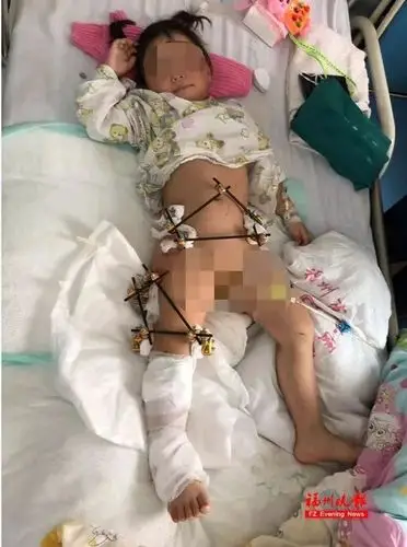 "为了避免给幼小孩子造成更大伤害,12处骨折全部通过微创修复.