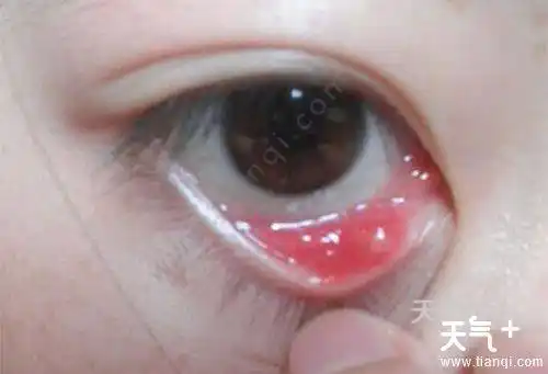 外部麦粒肿的初期症状很明显,刚开始的时候,可以明显看到眼睑处充血泛