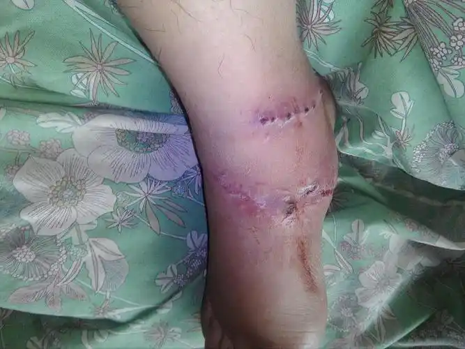 脚筋断了手术后一个月了,踝关节不能像正常那样弯曲正常_百度知道