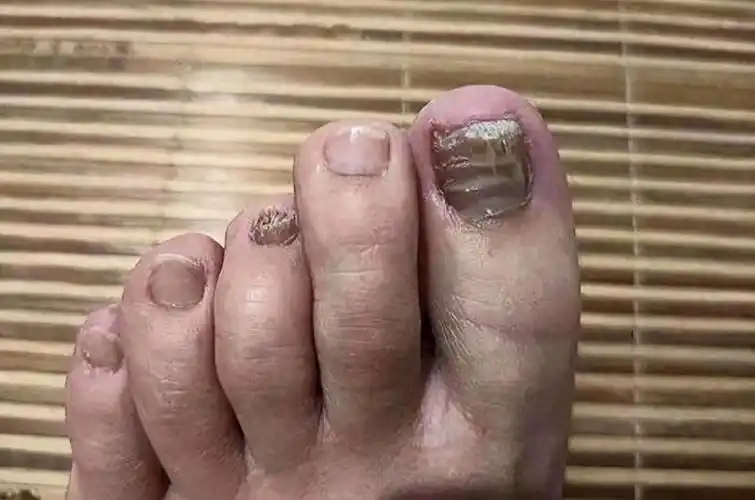 5年灰指甲终于治好了!简单几步,发黑增厚指甲蹭蹭掉!