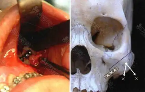 医院取钛钉过程图