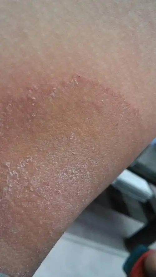 我大腿内测有小红片,晚上特别痒,经常想挠痒痒这是属于什么情况?