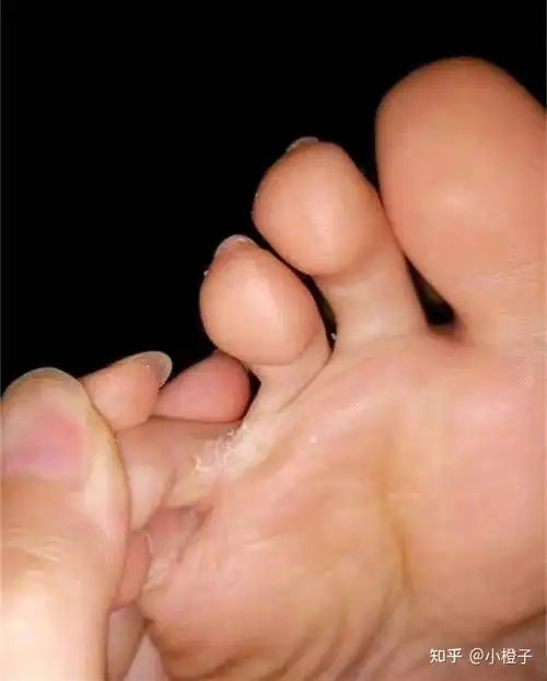 女生有脚气脚臭怎么办?11种方法帮到你 - 知乎