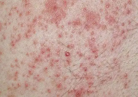 6种湿疹的类型和症状辨别图片大全_银屑病求医网