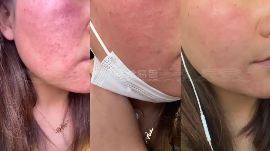 玫瑰痤疮皮肤屏障受损多久修复?_玫瑰痤疮_希易思