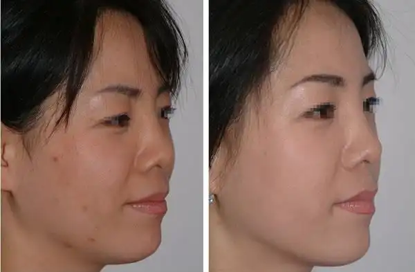 干细胞的面部脂肪移植对比案例 - 手术前后照片 - 韩国艺德雅整形外科