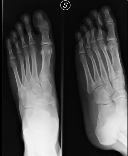 脚掌骨折拆石膏后多久可以正常行走 2010-08-18 为什麽骨折的人石膏拿