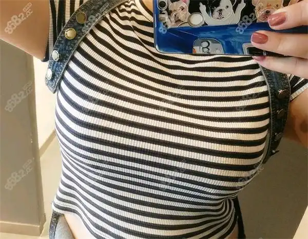 这女生本来胸部基础就不差,是b罩杯,经历一个月就恢复好了,自述脂肪