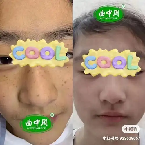 曲中周祛斑祛痘值得信赖一起变美