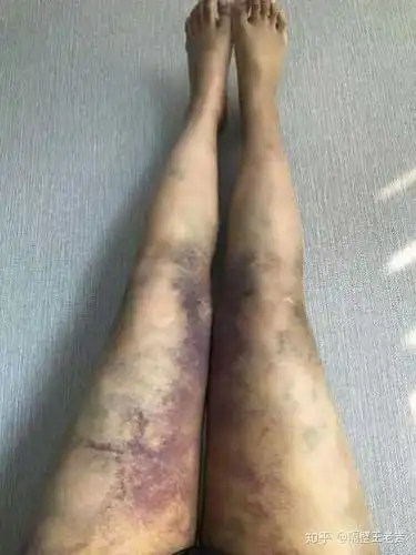 做大腿抽脂手术需要准备多少钱?