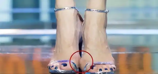 长了大脚骨就不能踢球?原来这么多明星都有拇外翻?