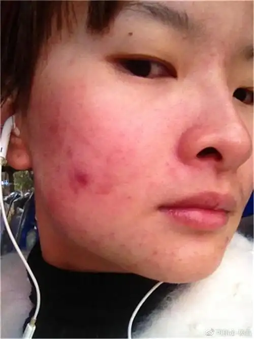 红血丝敏感肌必点