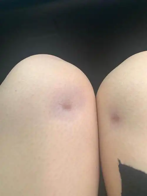 我2020年2月做的大腿吸脂