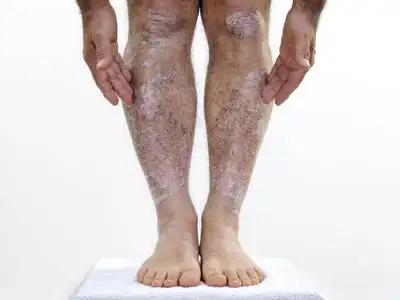 血毒引起的皮肤病图片