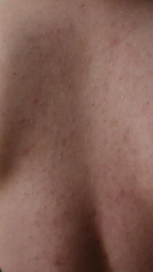 一到七八月份,遇见太阳天气,我的背部就痒,很难受,怎么回事这是?