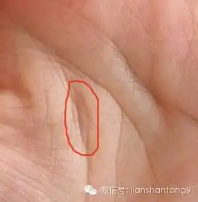 警惕手相里有这样的岛纹说明身体已有疾病