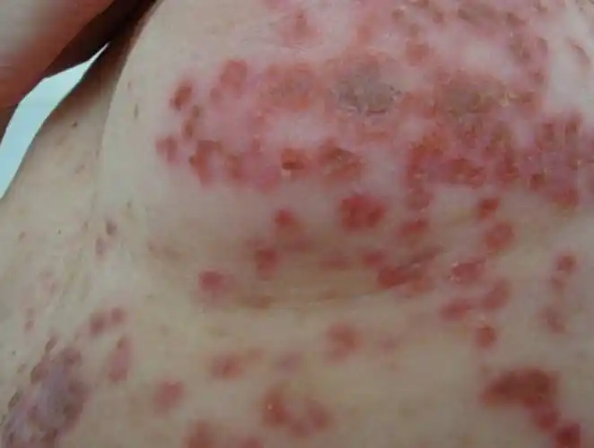 长沙皮肤专科医院丨湿疹解析成因症状与科学防治策略