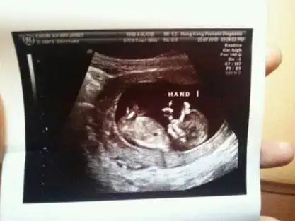 洪金宝的儿媳妇周家蔚在微博上秀出宝宝b超照