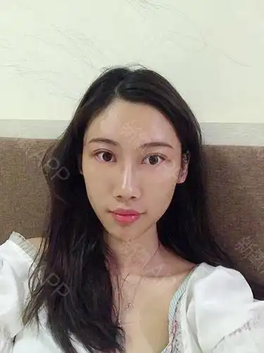 雪吻湿瞳孔自体脂肪丰泪沟术后第3天美丽日记_新氧整形