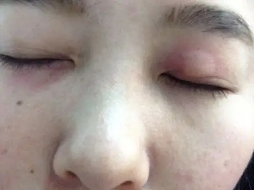 上眼皮和下眼皮长了包.