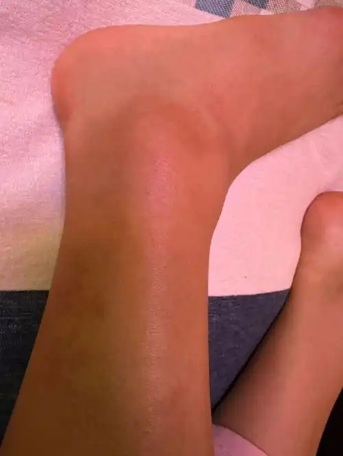 崴脚脚踝错位第12天