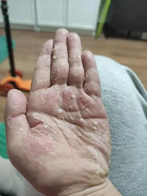 娃的手脱皮好严重