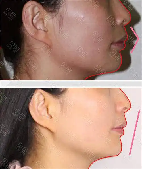 重庆正颌手术推荐医院盘点:这几家都是做牙齿矫正靠谱牙科!