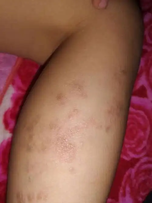 小孩子腿上长红斑,去县医院看了,给了点涂抹的药,感觉不起作用,大家