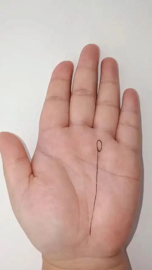 太阳线上方有岛纹